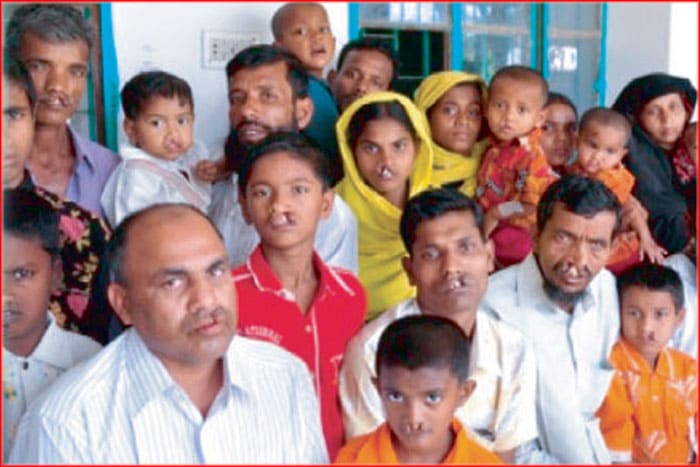 cleft lip palate