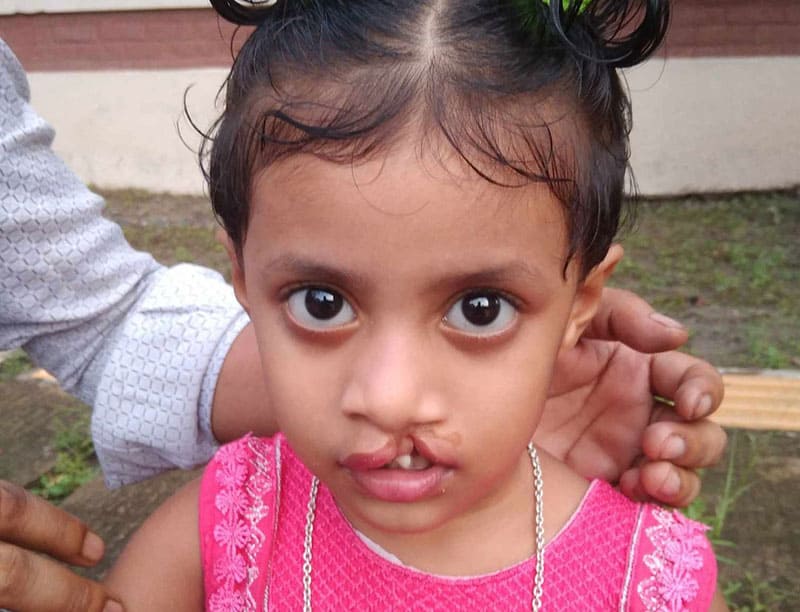cleft lip palate